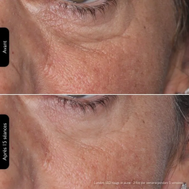 Silk'n Lumino - Masque LED de Luminothérapie 100 LEDs - Programmes automatiques - Séances anti-âge et anti-imperfections