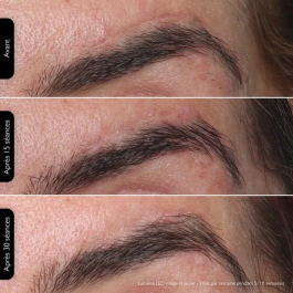 Silk'n Lumino - Masque LED de Luminothérapie 100 LEDs - Programmes automatiques - Séances anti-âge et anti-imperfections