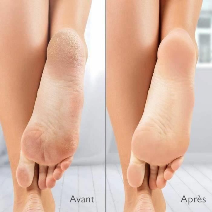 Silk'N SIL8712856073061 Removedor de Callos Eléctrico con Succión Incorporada y 2 Limas Incluidas 4 Silk'N SIL8712856073061 Removedor de Callos Eléctrico con Succión Incorporada y 2 Limas Incluidas 4