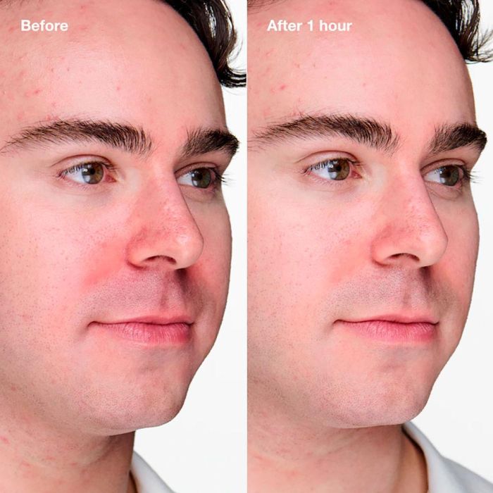 Clinique Anti-Blemish Solutions Clinical Gel Avanzado Anti-Imperfecciones 20 ml 1