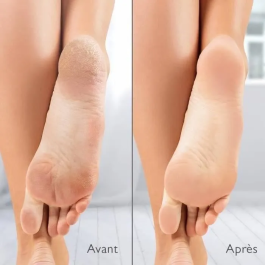 Silk'N SIL8712856073061 Removedor de Callos Eléctrico con Succión Incorporada y 2 Limas Incluidas