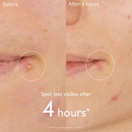 Caudalie VINOPURE stop granos salicílico Tratamiento Acné, Poros y puntos negros 15 ml